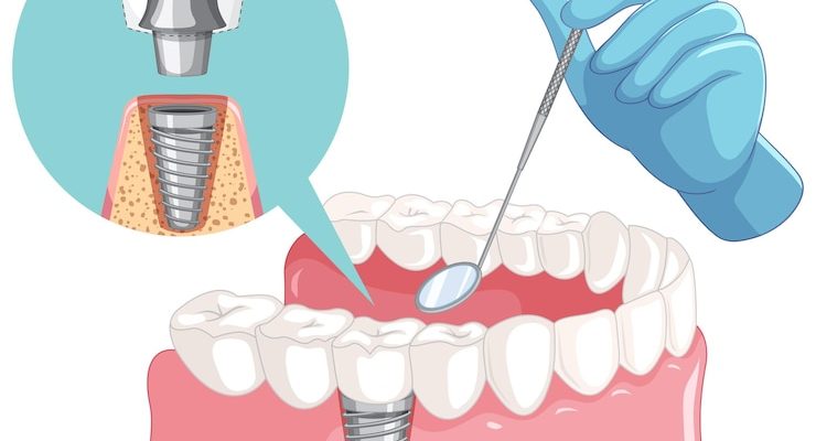 ABOUT DENTAL IMPLANTS IN REIDSVILLE, NC