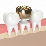 Your Ultimate Guide to Fillings by a Composite Fillings Dentist_FI