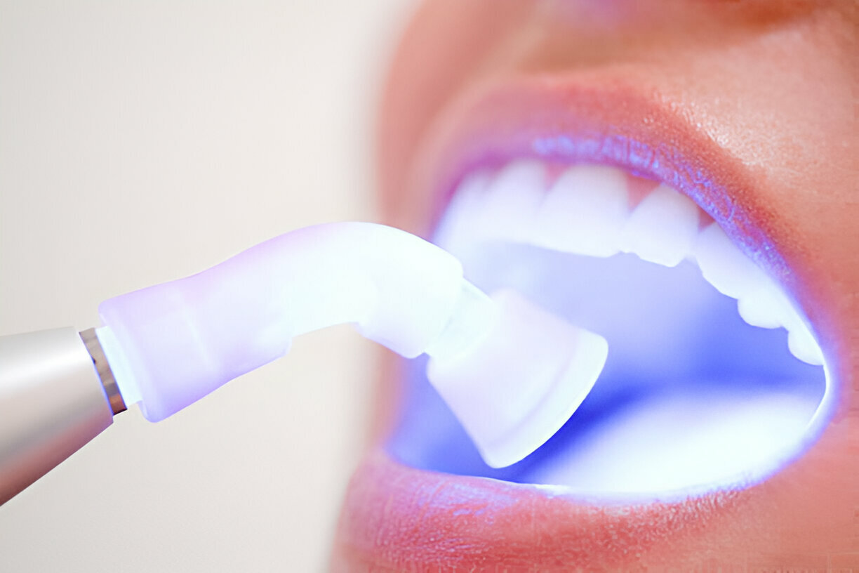 Brighten Your Smile with Professional Teeth Whitening – Trusted Dentist in Reidsville, NC at Caring Modern Dentistry_1