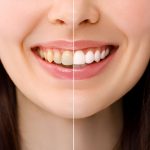 Brighten Your Smile with Professional Teeth Whitening – Trusted Dentist in Reidsville, NC at Caring Modern Dentistry_FI