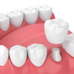 How Long Do Dental Crowns Last? Tips for Maintaining Your Crowns in Reidsville, NC