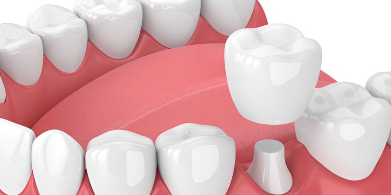 How Long Do Dental Crowns Last? Tips for Maintaining Your Crowns in Reidsville, NC